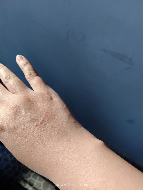 Kulit alergi, muncul bintik gatal di punggung tangan dan badan