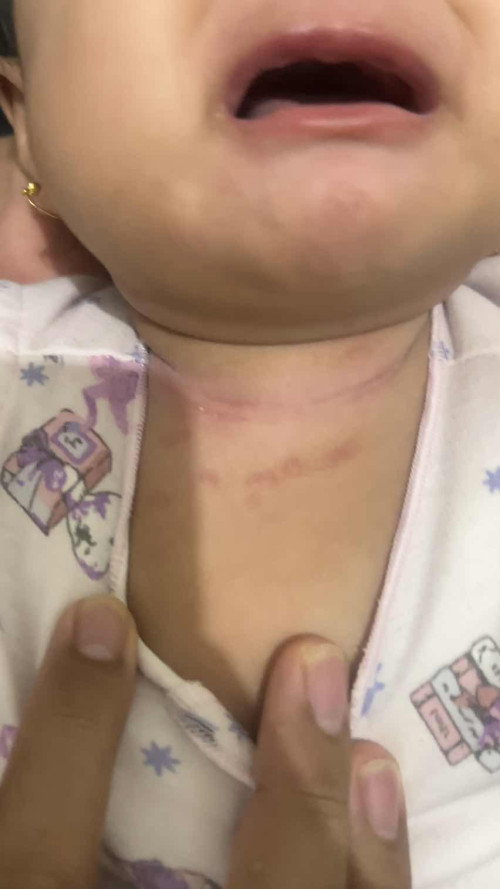 bentol” pada bayi