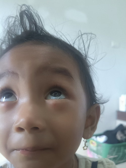Kalazion anak 2 tahun