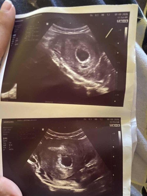 แม่ๆคิดว่าน้องจะได้ไปต่อไหมค่ะ 6w5d