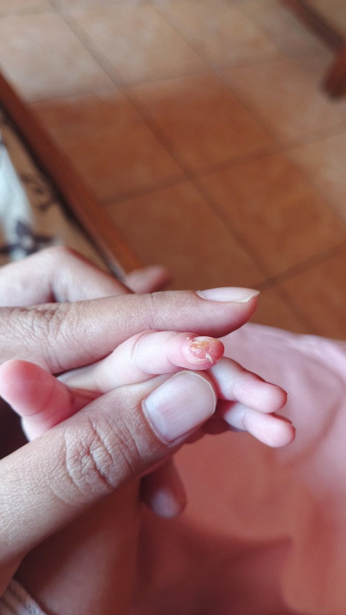 Jari bayi melepuh