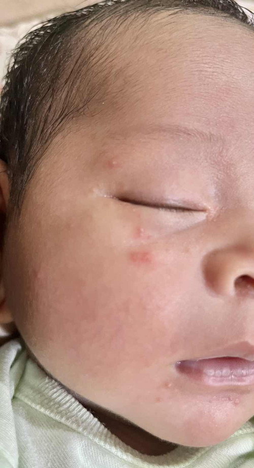 Kulit merah gatal