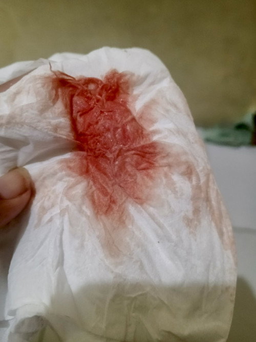 Flek 13 minggu