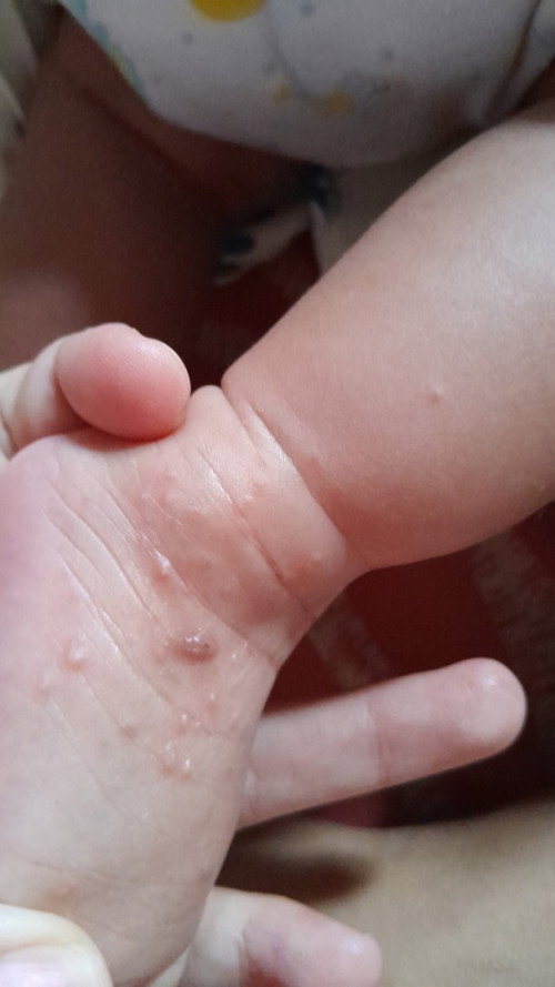 Mlentis di badan dan kaki bayi