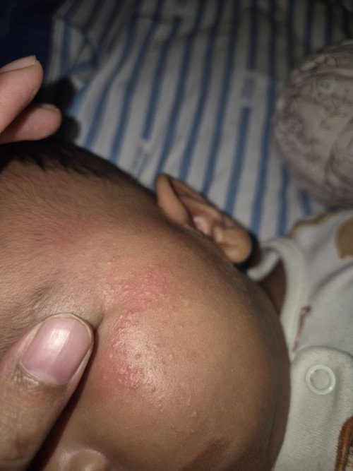 Iritasi ruam kulit bayi