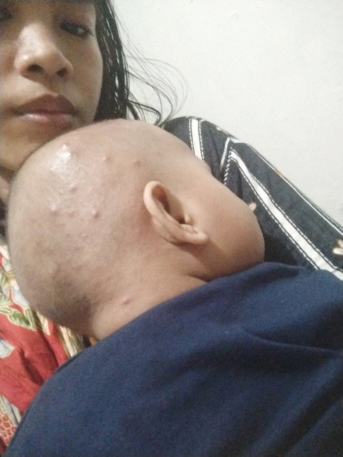 Bisul di kepala bai 11bulan