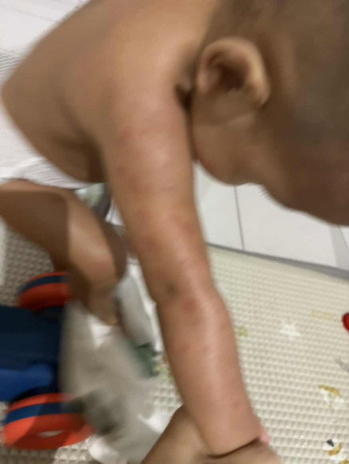 Bentol2 merah seluruh badan tapi tidak gatal