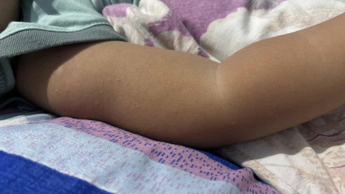 Bumps on my 18 month old’ skin