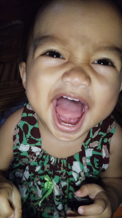 Tongue tie