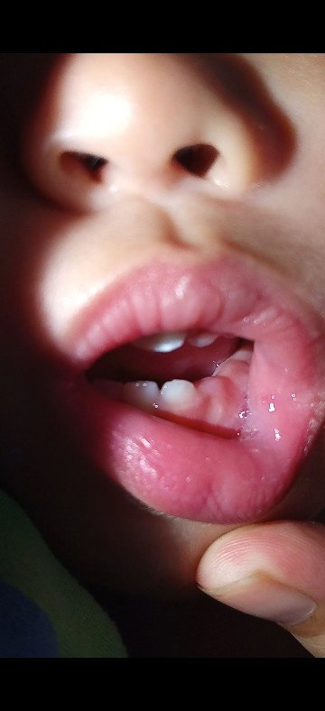 Nag te-teething po ba sya, parang maga po kasi gums nya then may lagnat rin po?