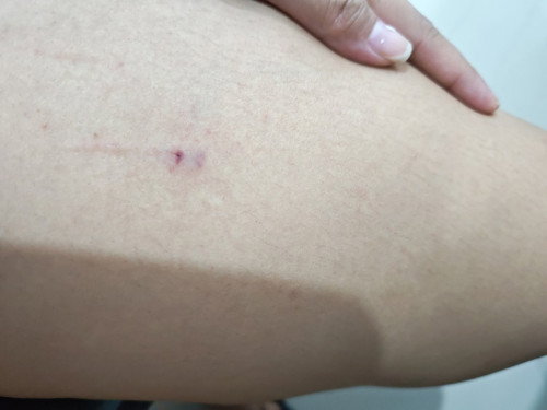 Hello. New mom here. Nakalmot ako ng pusa. E ayoko mag pa anti rabies , any experience?