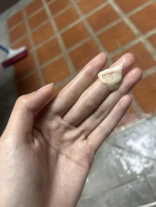 แบบนี้คือปกติไหมคะ แล้วมันเรียกว่าอะไรหรอคะ เป็นประมาณ 3 ครั้ง อายุครรถ์ในตอนที่เจอประมาณ 12-13 สัปดาห์ ท้องแรก ไม่คันค่ะ