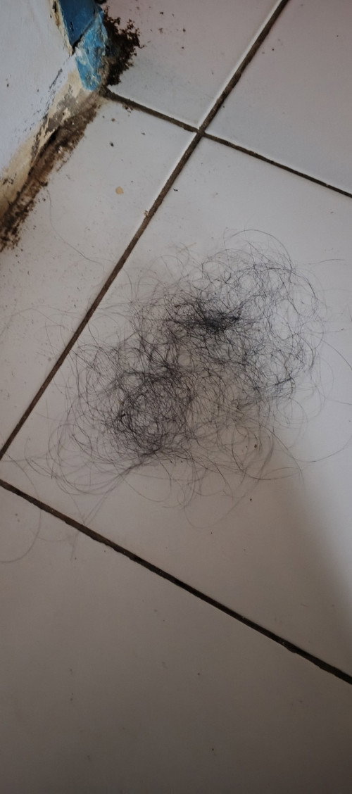 Postpartum Hair Loss