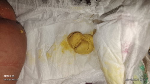 Bun mau tanya dungg bayi usia 1 bulan pup nya keras dan kuning pucat apakah normal bagi Saranya dung