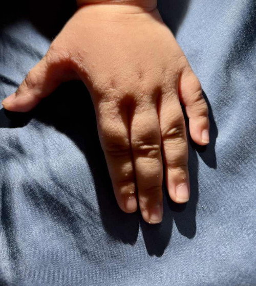 skin colored bumps sa kamay