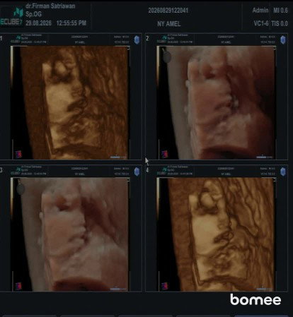 Diagnosa bibir sumbing