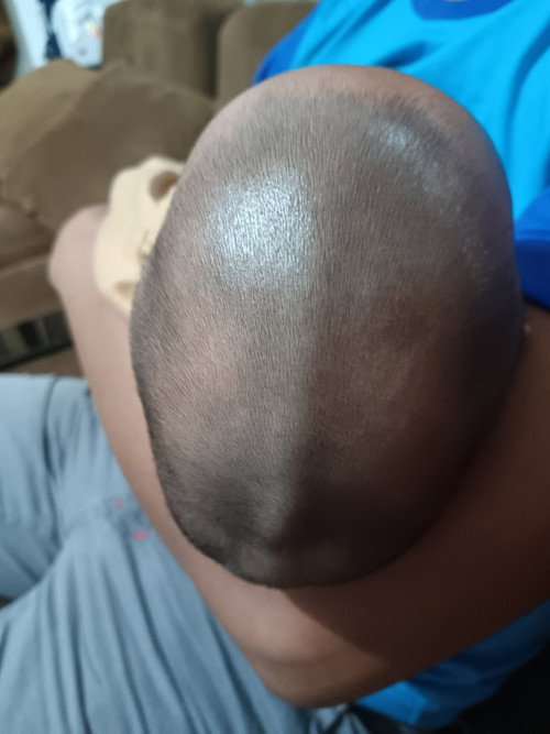 Craniosynostosis