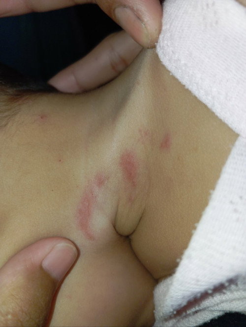 ruam dileher bayi 6 bulan
