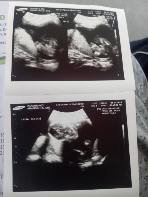 frank breech 22 weeks
