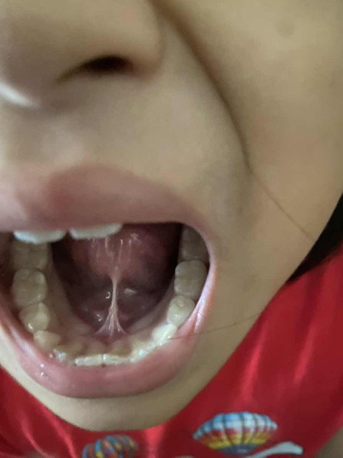 Tongue-Tie Ke Atau Masalah Pertuturan? Mohon Pandangan Ibu-Ibu 🙏🏻