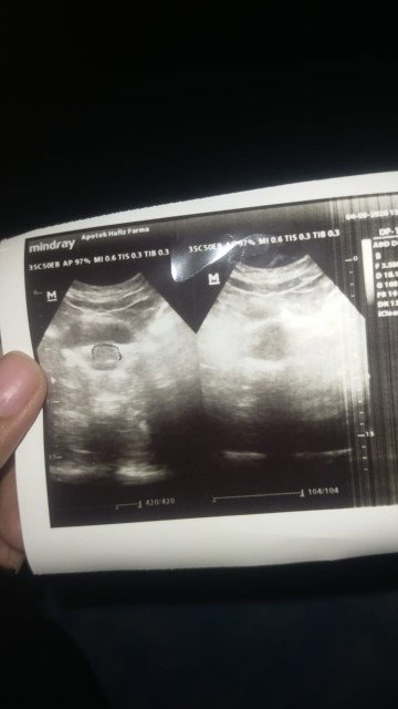 Kehamilan 8w5d