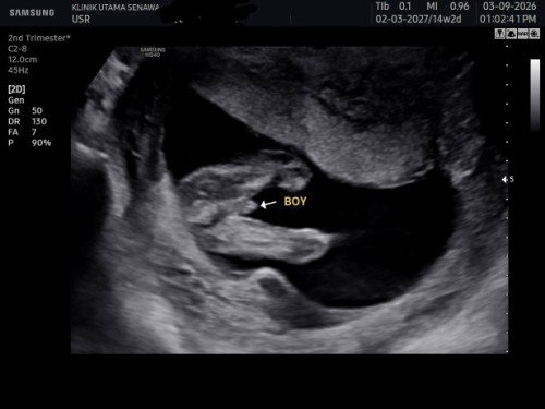 Gender baby