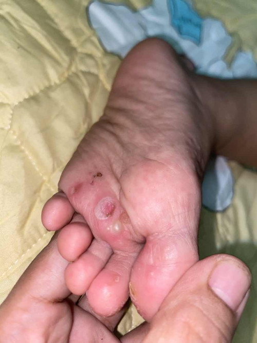 ลูก2ขวบ3เดือน เป็นผื่นคันไม่หายสักที