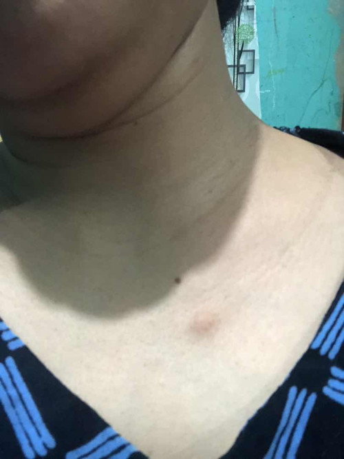 Benjolan kaya bentol tapi keras