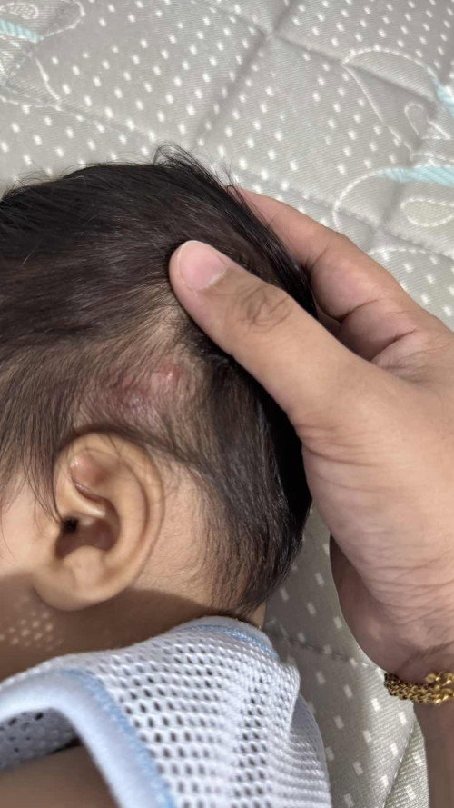 Kepala bayi timbul benjolan seperti Bisul