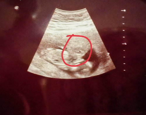 Ada fibroid masa mengandung, tlg share pengalaman ibu2