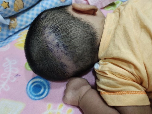 ลูกผมหายไปเป็นแนวยาว