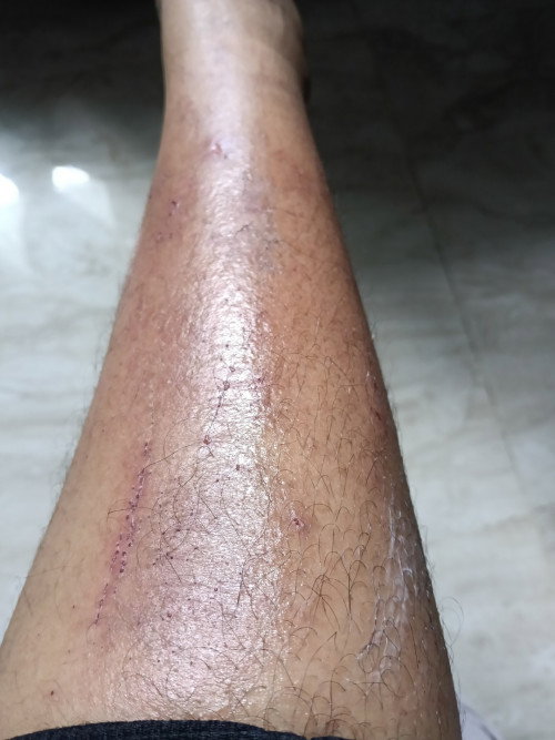 Kaki gatal and kemerahan