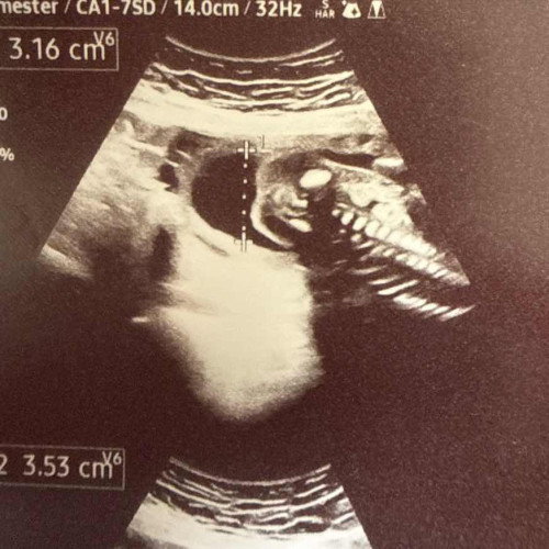 19 weeks and 6 days baby gender