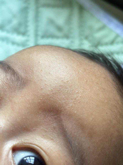 Ruam kt muka baby