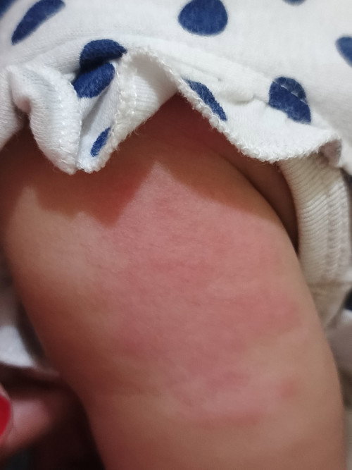 Kulit bayi 8 bulan kemerahan