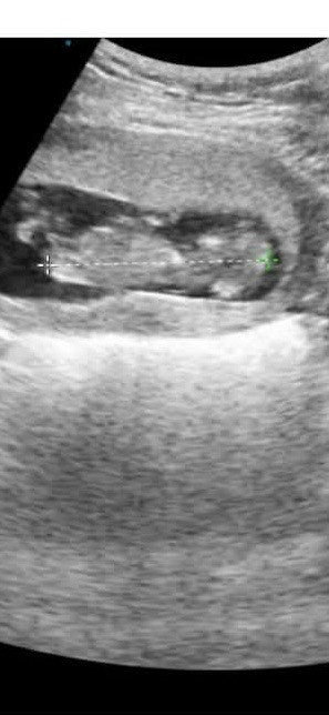 12weeks and 2days