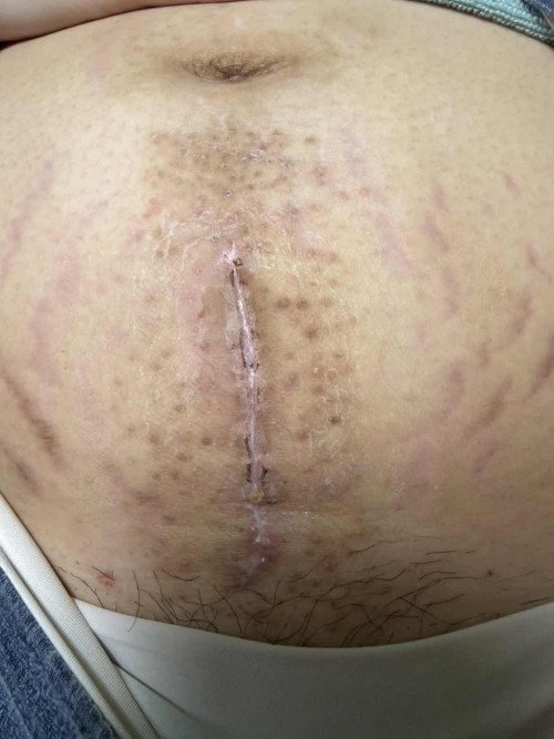 CS Scar to rescue - FTM