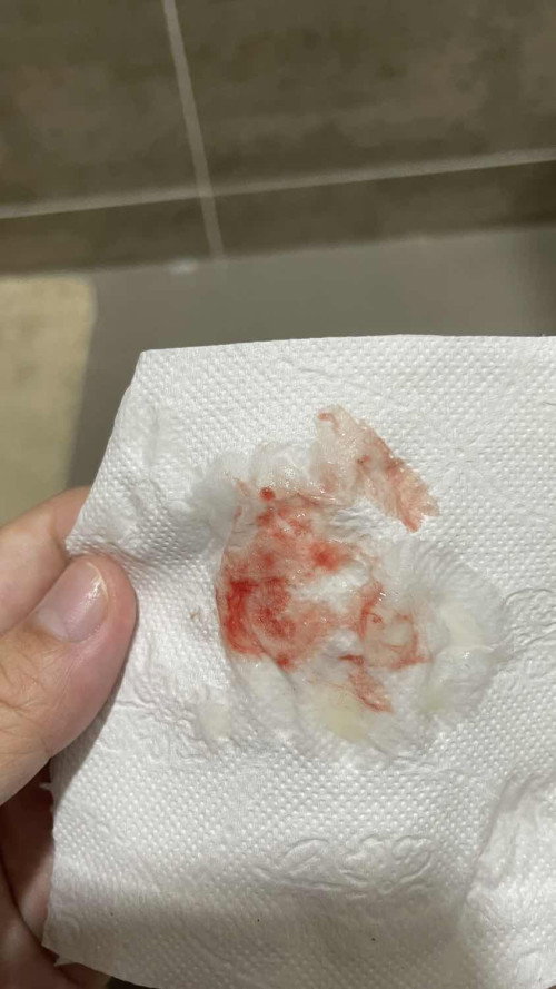 ท้อง 36 วีค มีมูกแบบนี้
