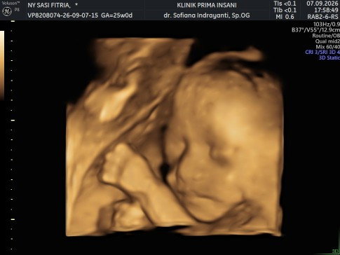 26 week. Usg 4D