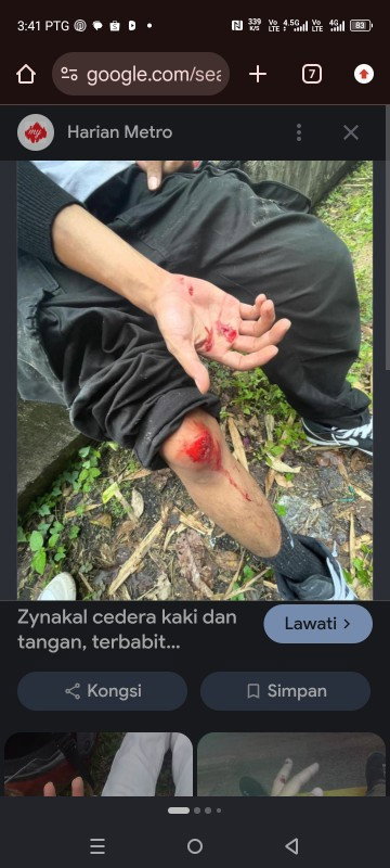 Jahitan guting beranak normal