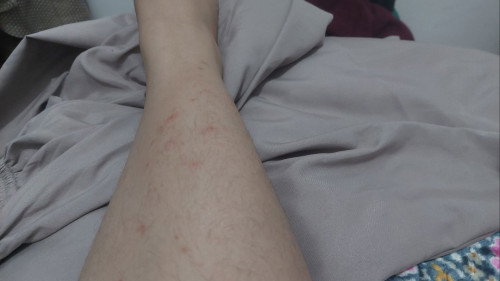 Bintik merah gatal