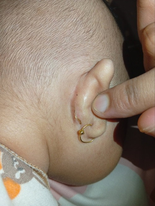 Lecet dibelakang kuping