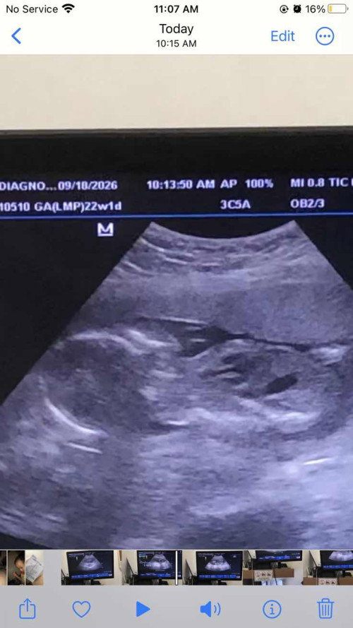 Guess mi Pihikan si baby naka Breech