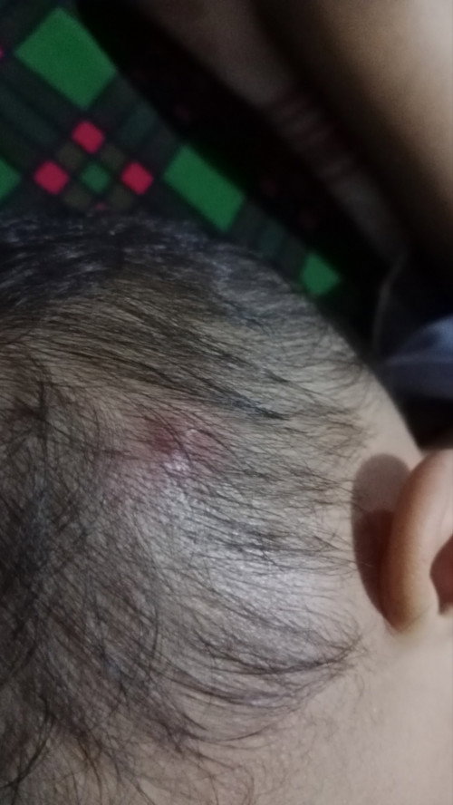 Benjolan dikepala di atas telinga