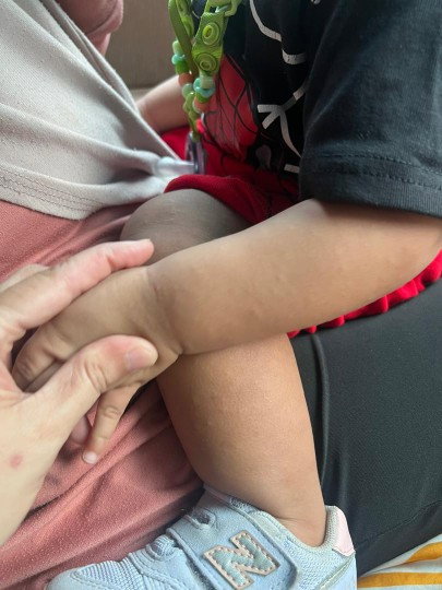 Kulit anak flare