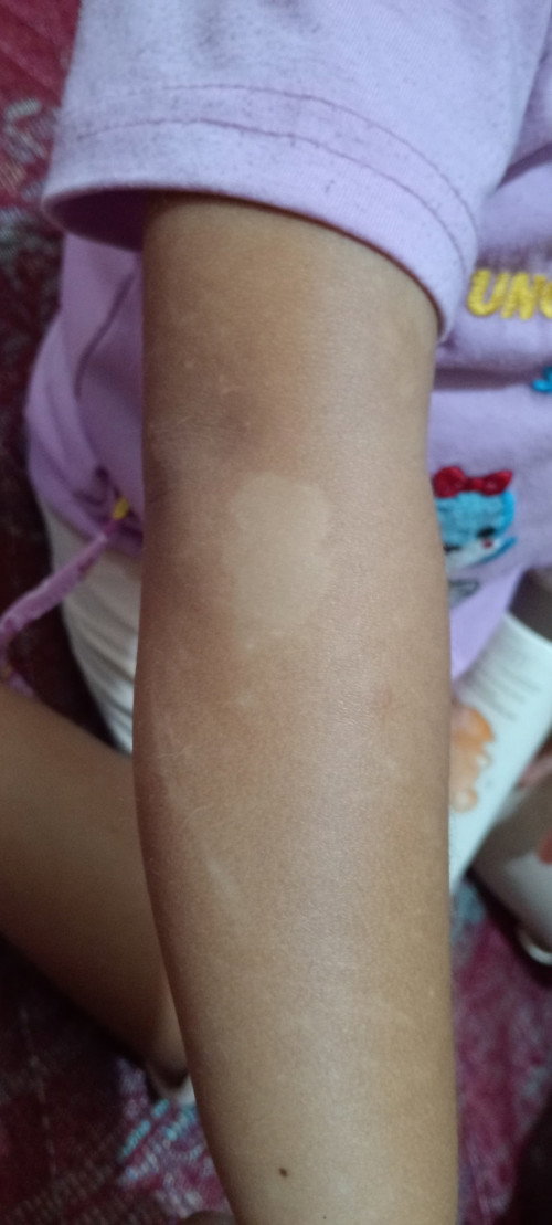 Buun... Mau tanya ini tangan anaku tadinya kaya kena cacar gitu tapi cacar yg melepuh ky terbakar