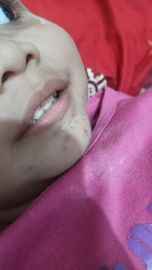 Bintik merah setelah demam