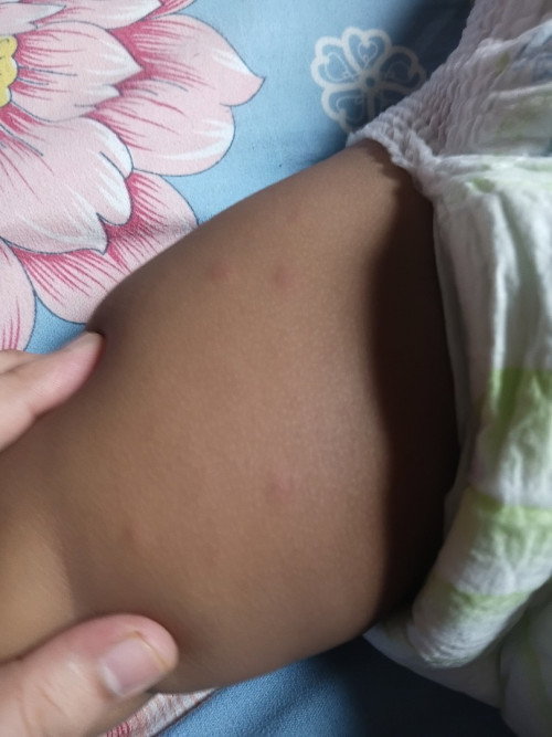 CAMPAK/ALLERGIC