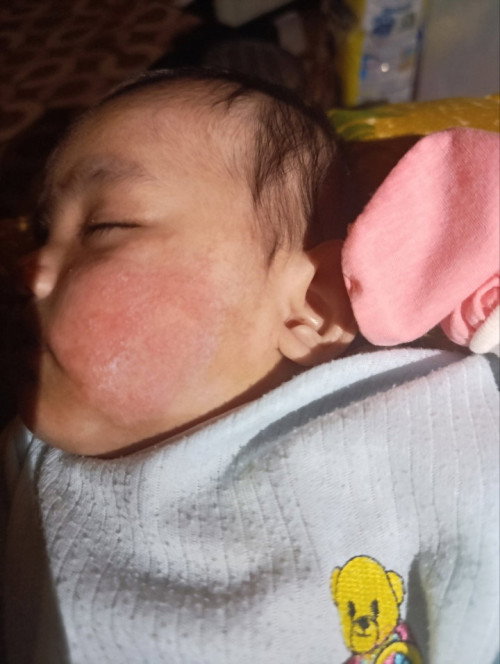 #Seputar Bayi
Merah merah pada wajah bayi, kasar dan gatal.