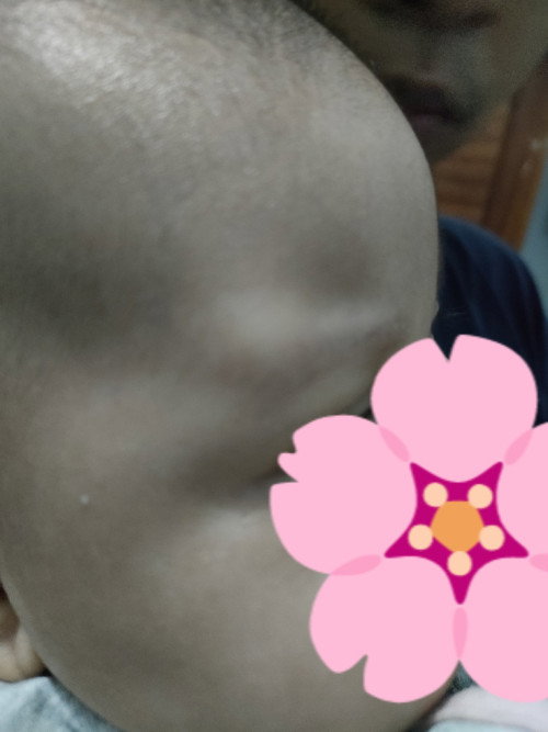 Benjolan di atas alis bayi 2 bulan